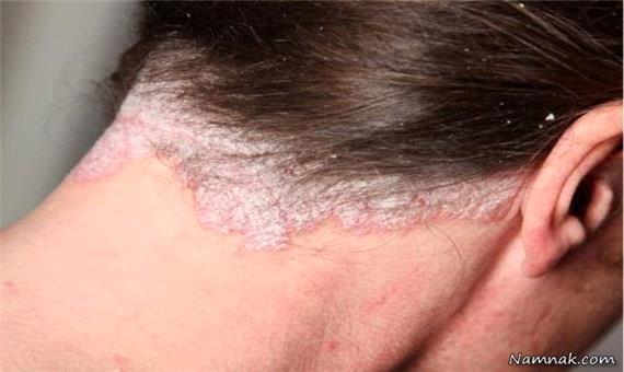 یک متخصص پوست: درماتیت سبورئیک درمان می‌شود