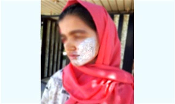 سوزاندن دست و صورت دختر نوجوان با اتوی داغ توسط نامادری اش
